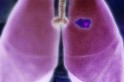 Câncer de pulmão pode ficar escondido por 20 anos, diz estudo (Foto: Eric D. Smith, Dana-Farber Cancer Institute/Divulgação)